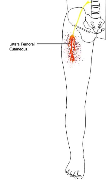 meralgia paresthetica physical exam